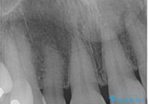 矮小(わいしょう)歯の形をセラミックで自然に 50代女性の治療前
