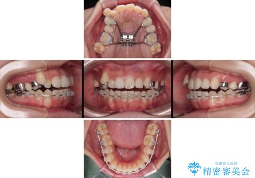 急速拡大装置　狭い歯列を拡大して短期間での矯正治療の治療中