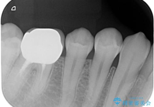ジルコニアクラウンの治療後