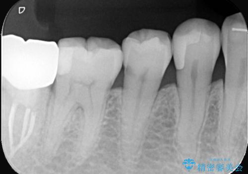 セラミックインレーによる虫歯治療の治療前