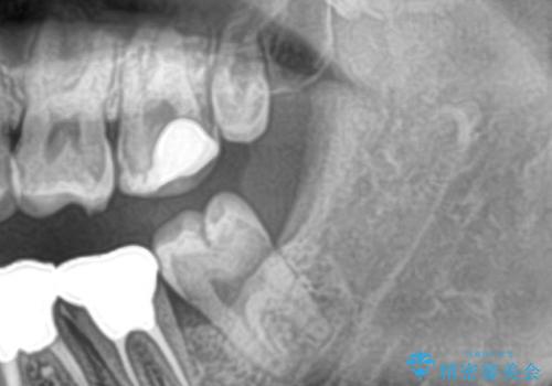 親知らず抜歯の治療前