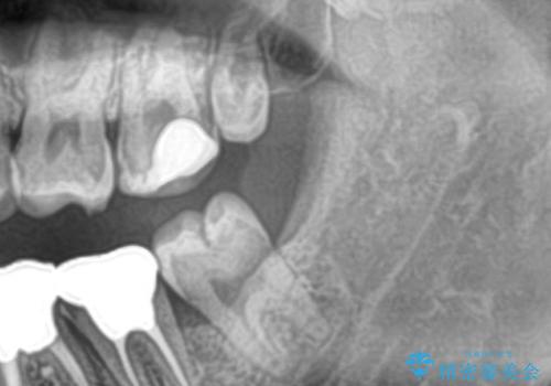 まっすぐ生えた親知らず抜歯