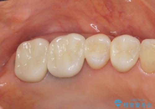[ セラミック治療 ]  保険治療でいれた銀歯を白くしたいの治療後