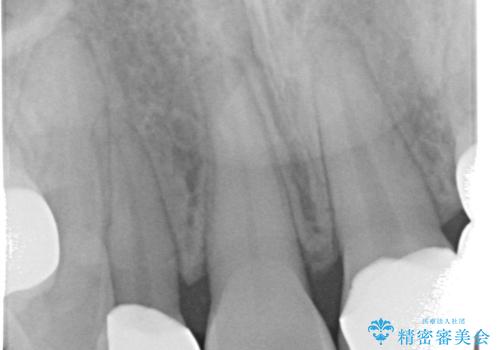前歯の審美的なブリッジ (歯列矯正後)の治療後