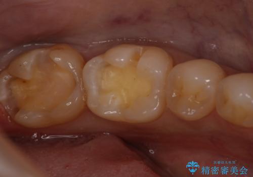 奥歯を綺麗にしたいの治療中