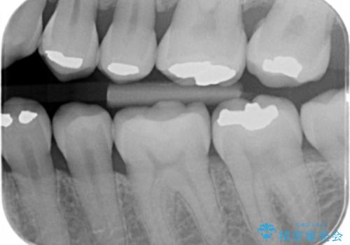 アマルガムを除去 虫歯を除去して、セラミックのつめものにの治療前