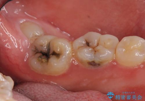 歯冠長延長術をおこなったアプローチの難しい虫歯治療の症例 治療前