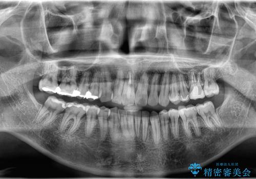 【インビザライン　非抜歯】歯の捻じれと歯のでこぼこを治したい!の治療後