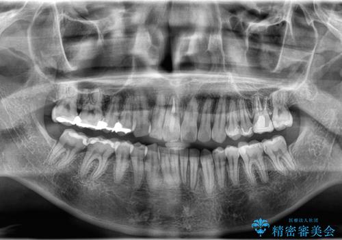 【インビザライン 非抜歯】歯の捻じれと歯のでこぼこを治したい!の治療後