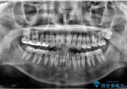 【インビザライン 非抜歯】歯の捻じれと歯のでこぼこを治したい!の治療前