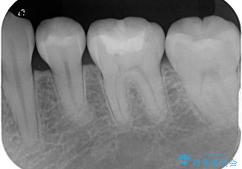詰め物の下が黒いのが気になる　セラミックインレー修復の治療前
