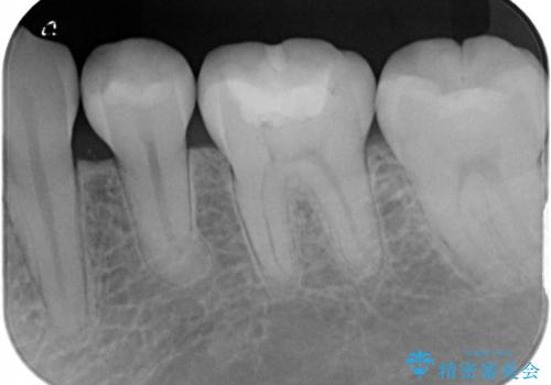 詰め物の下が黒いのが気になる セラミックインレー修復の治療前