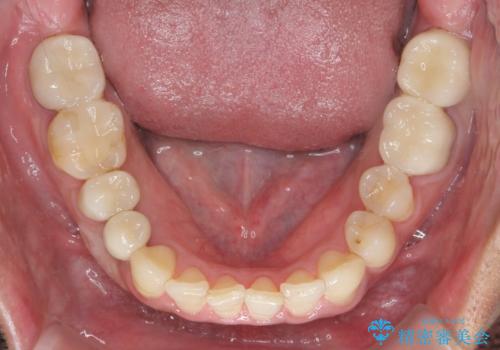 歯並びと虫歯(メタルフリー)を行った全顎治療の治療後