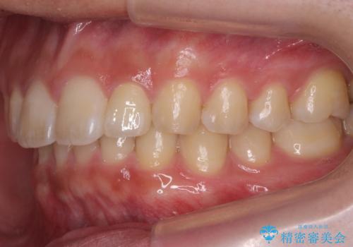 前歯のすき間 小さい歯がある 前歯の並びをきれいにしたいの治療後