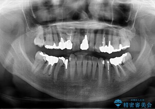 50代女性　銀歯をとって白いつめものに　全体的な治療の治療前
