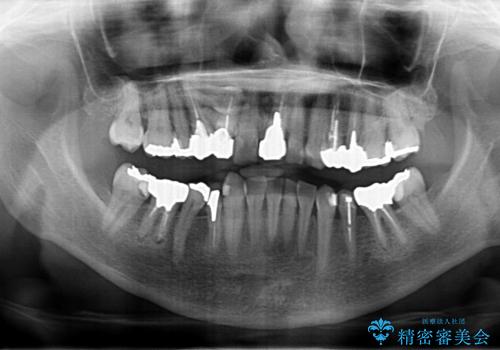 50代女性 銀歯をとって白いつめものに 全体的な治療の治療前