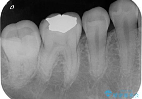 プラチナ金合金のインレー治療の治療後