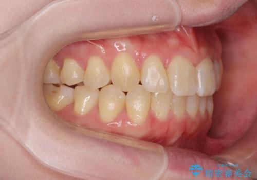 前歯のねじれを治したい リーズナブルなインビザラインモデレートプランの治療後