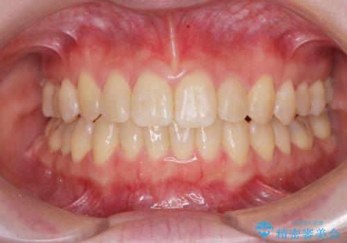 前歯のねじれを治したい リーズナブルなインビザラインモデレートプランの症例 治療後