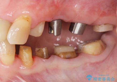 セラミック インプラント 全顎治療の治療中