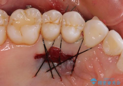 強烈な知覚過敏 歯肉移植術で根面被覆の治療後