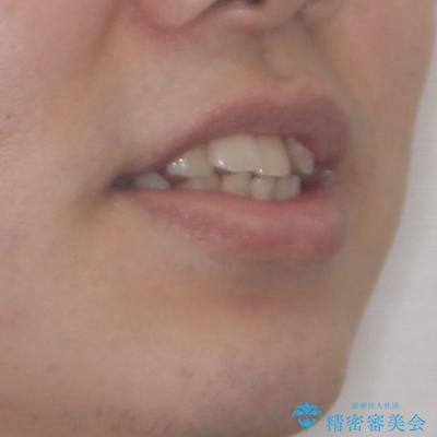 デコボコと口元の突出感を改善 抜歯矯正治療の治療前(顔貌)