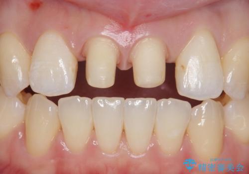 前歯を綺麗にしたい。の治療中