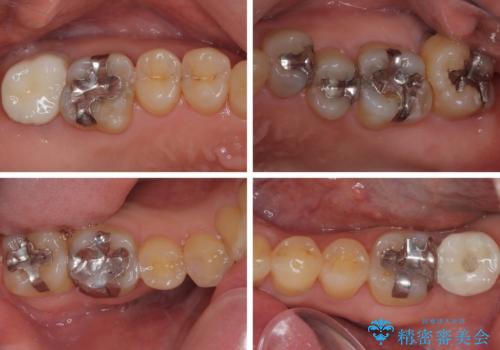 外側に飛び出している歯 部分矯正を用いた奥歯の補綴治療の治療後