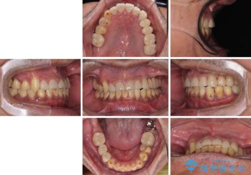 反対咬合ですり減った前歯とむし歯だらけの奥歯　総合歯科治療の治療後
