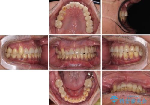 反対咬合ですり減った前歯とむし歯だらけの奥歯 総合歯科治療の治療後