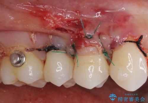 強烈な知覚過敏 歯肉移植術で根面被覆の治療前