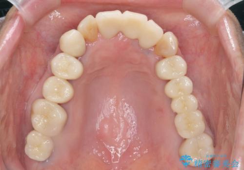 セラミック インプラント 全顎治療の治療後