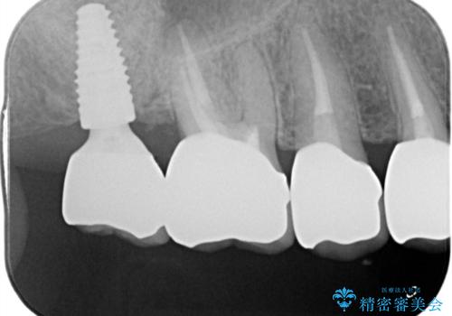 見た目の悪いクラウンをやりかえたいの治療後