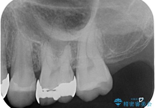 銀歯がとれた セラミックインレー修復の治療前