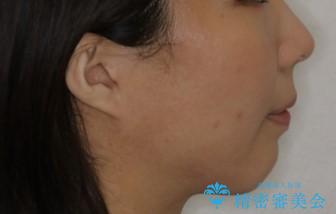 どこで噛んだらいいのかわからない:ワイヤーによる矯正治療の治療後(顔貌)