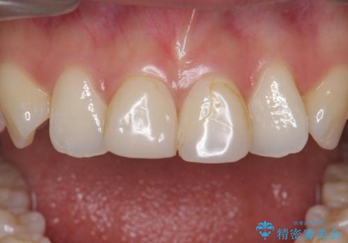 前歯を綺麗にしたい。の治療前