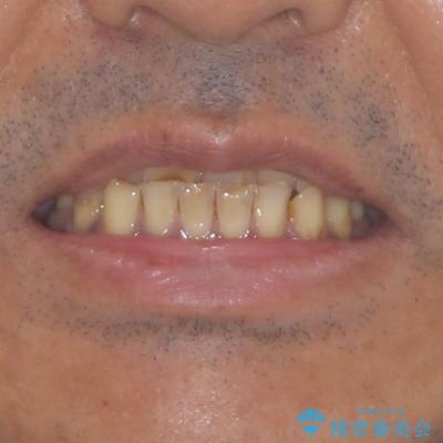 反対咬合ですり減った前歯とむし歯だらけの奥歯 総合歯科治療の治療前(顔貌)