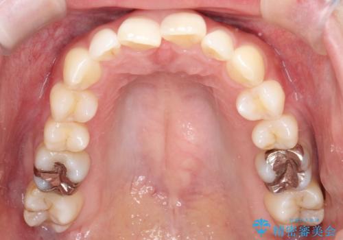 インビザラインで整えた前歯の歯並びの治療前
