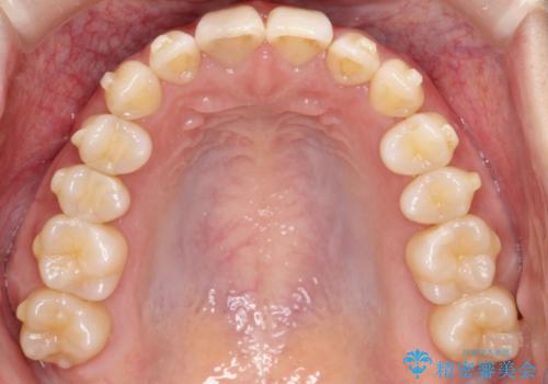 ディープバイト改善のためのインビザライン治療の治療中