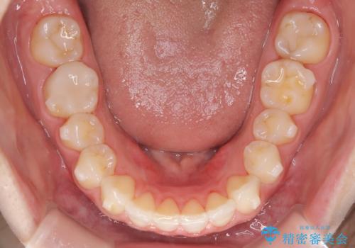 抜歯矯正をインビザラインで実現の治療中