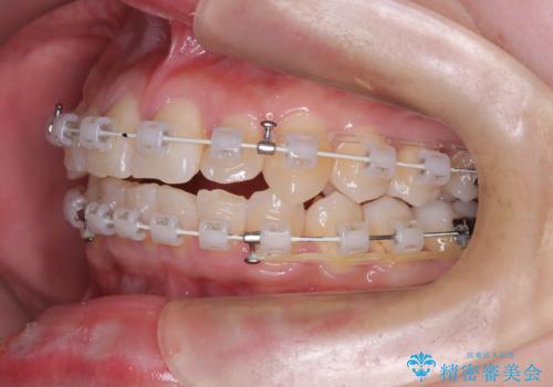 非抜歯で整える前歯の矯正の治療中