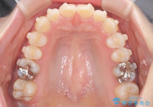 インビザラインで整えた前歯の歯並びの治療中