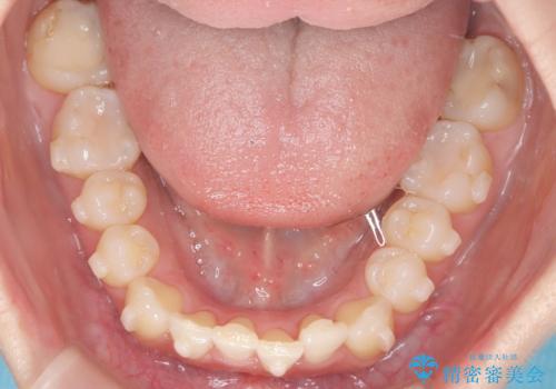 インビザラインで整えた前歯の歯並びの治療中