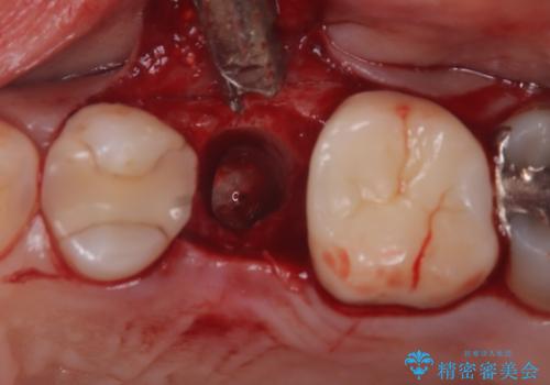 左上第一小臼歯のインプラント治療の治療中