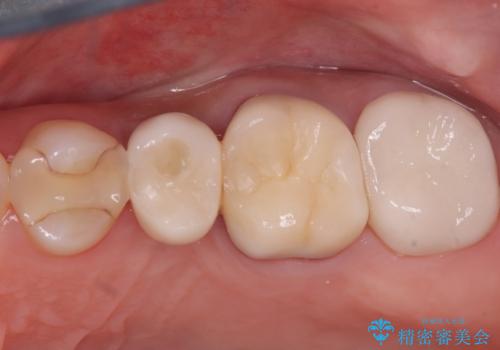 左上第一小臼歯のインプラント治療の治療後
