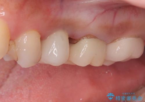 左上第一小臼歯のインプラント治療の治療後