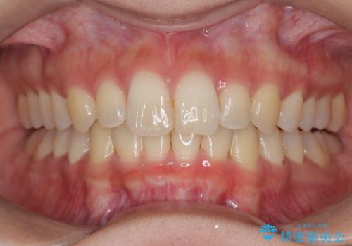 ディープバイト改善のためのインビザライン治療の治療後