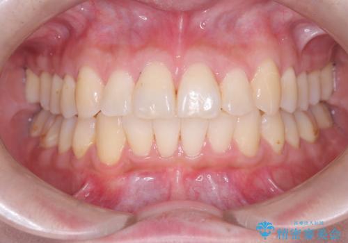 非抜歯で整える前歯の矯正の症例 治療後