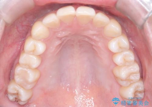非抜歯で整える前歯の矯正の治療後