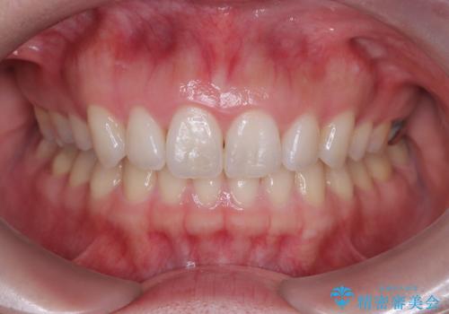 抜歯矯正をインビザラインで実現の治療後